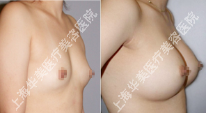 华美假体隆胸案例
