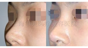 彩光嫩肤案例对比